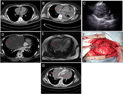 Case Report: A Young Man With Giant Pericardial Synovial Sarcoma